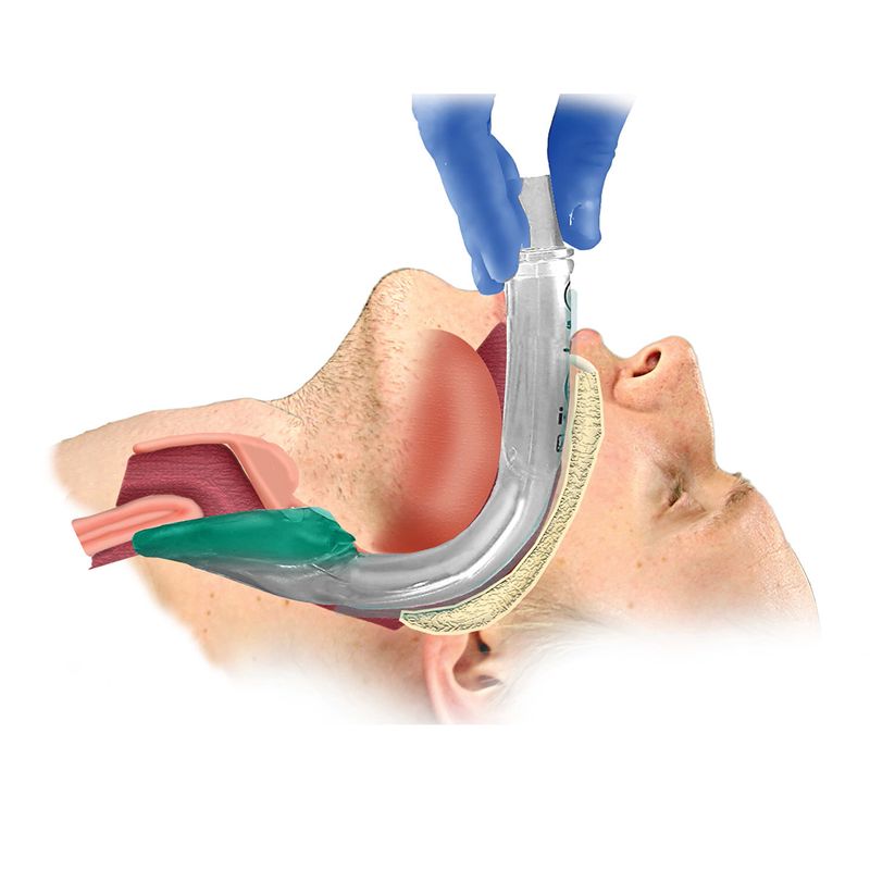 Larynxmaske i-gel kit str 5